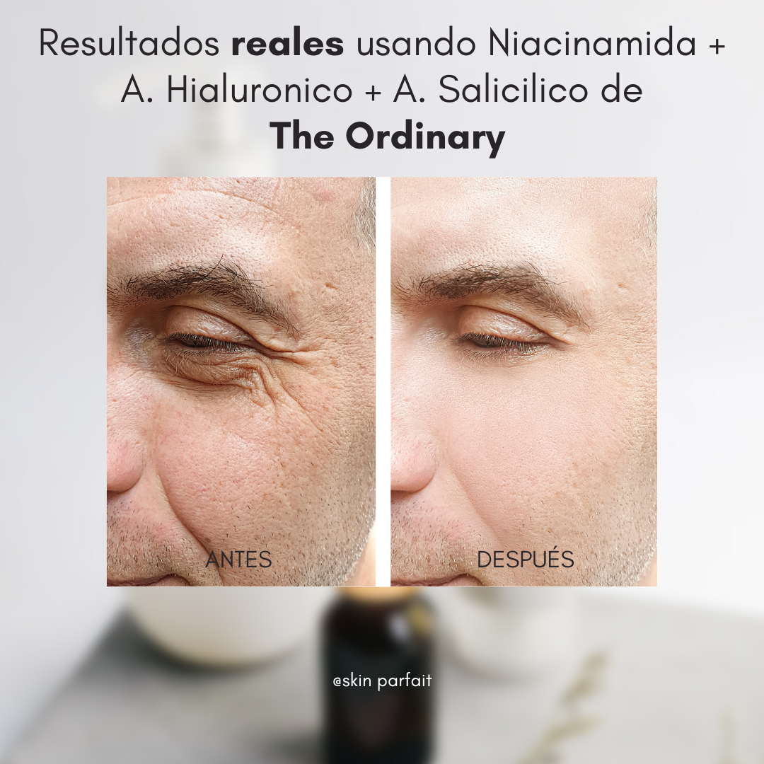 Edicion Dia del Padre: Niacinamida + Acido Salicilico + Acido Hialuronico de The Ordinary.