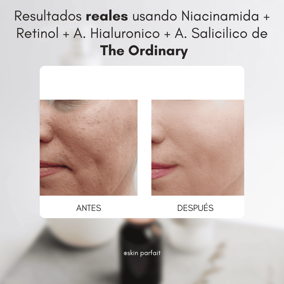 EL SUPER COMBO: Niacinamida + Retinol + A. Hialuronico + A. Salicilico The Ordinary